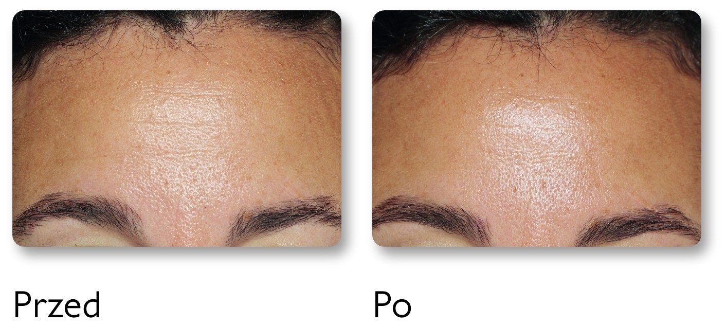 Before and after images showing improved skin texture on a forehead. The left side is rougher, the right side is smoother.