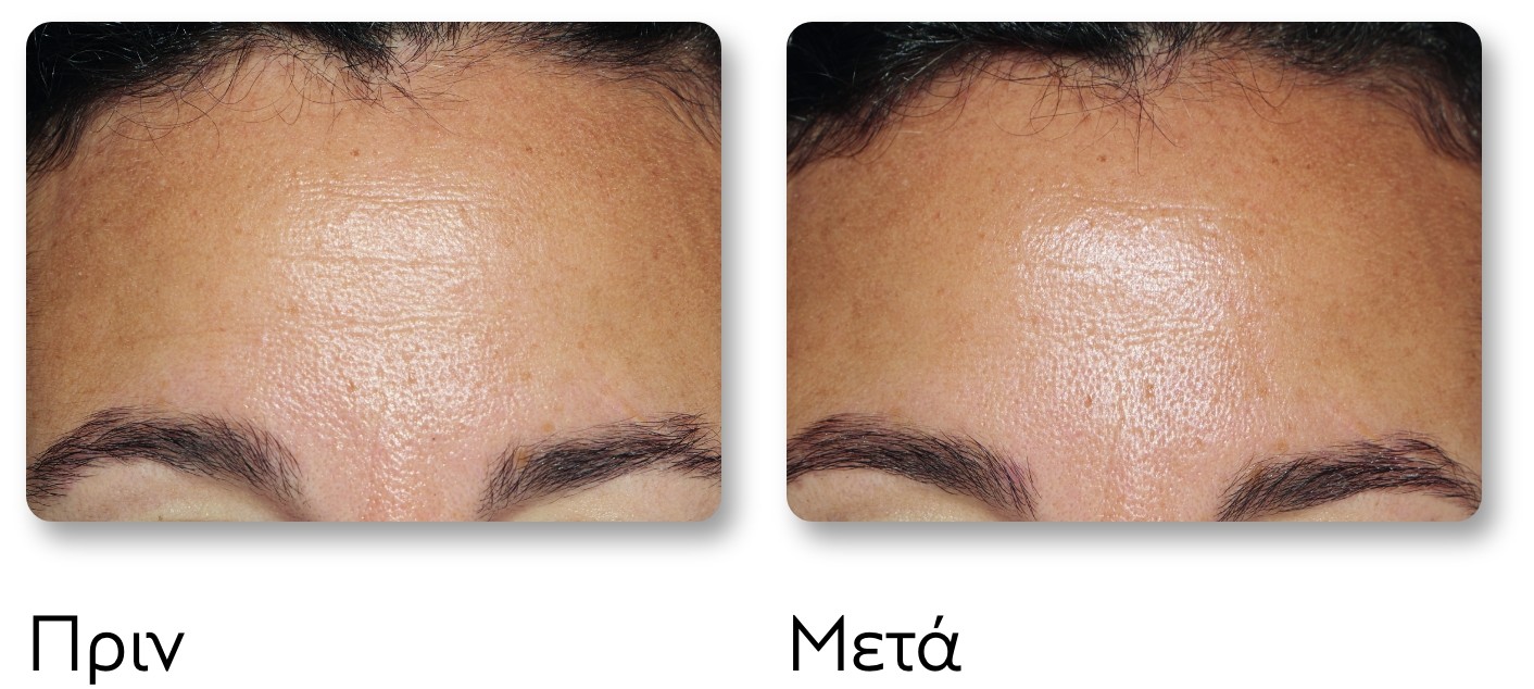 Before and after images showing improved skin texture on a forehead. The left side is rougher, the right side is smoother.
