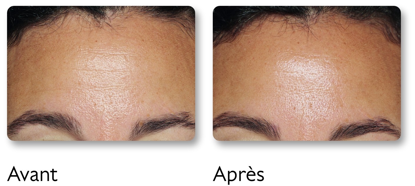 Before and after images showing improved skin texture on a forehead. The left side is rougher, the right side is smoother.