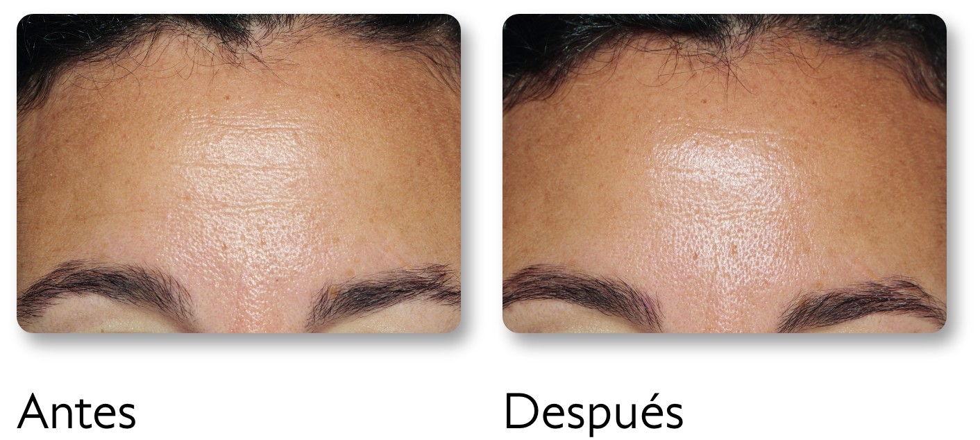 Before and after images showing improved skin texture on a forehead. The left side is rougher, the right side is smoother.