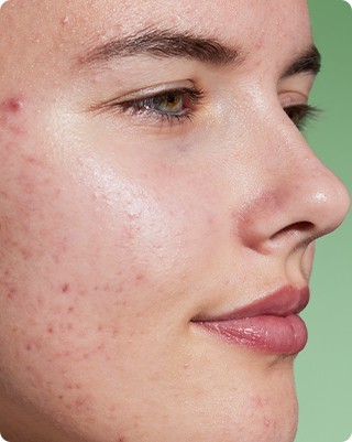 Imperfections du visage