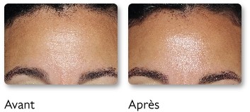 Close-up of a forehead before and after treatment, showing reduced shine and smoother texture. Labeled "Avant" and "Après."